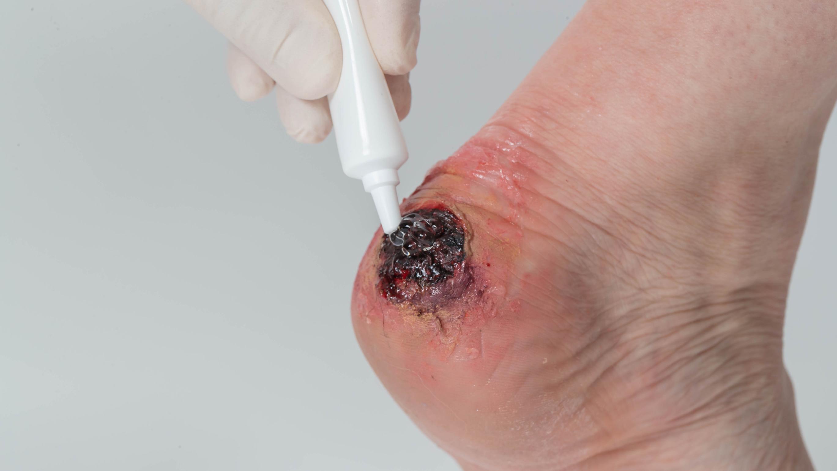 Person with a wound on their foot applying the wound care product Amorphous Hydrogel